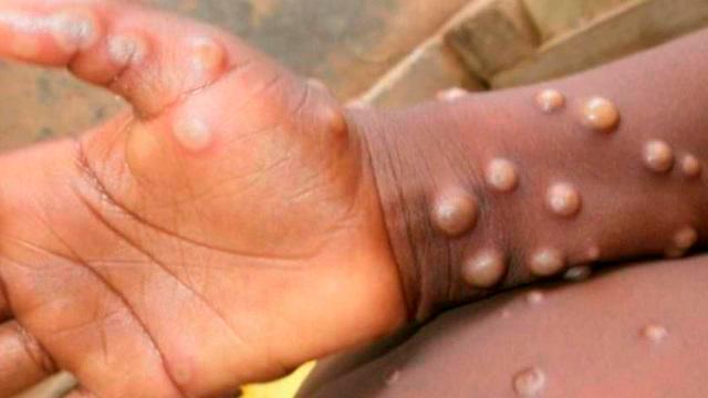  Monkeypox Cases Continue To Rise In Nigeria